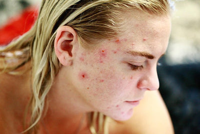 What is the difference between rosacea and acne? We clarify! 