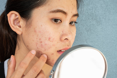 What causes pimples and how do I get rid of them? 