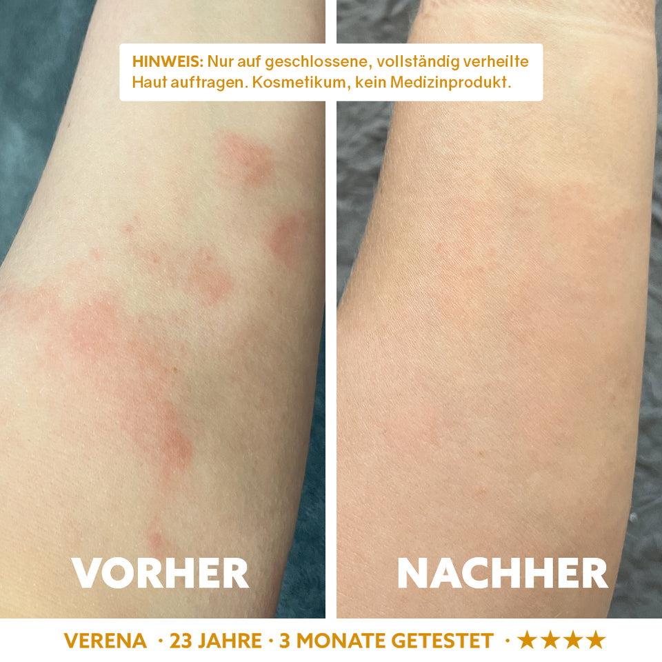 Neuro-Sensitive Skin Serum 'Dermasoothe'